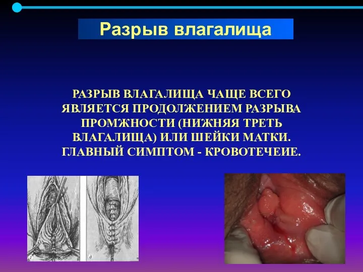 РАЗРЫВ ВЛАГАЛИЩА ЧАЩЕ ВСЕГО ЯВЛЯЕТСЯ ПРОДОЛЖЕНИЕМ РАЗРЫВА ПРОМЖНОСТИ (НИЖНЯЯ ТРЕТЬ ВЛАГАЛИЩА) ИЛИ