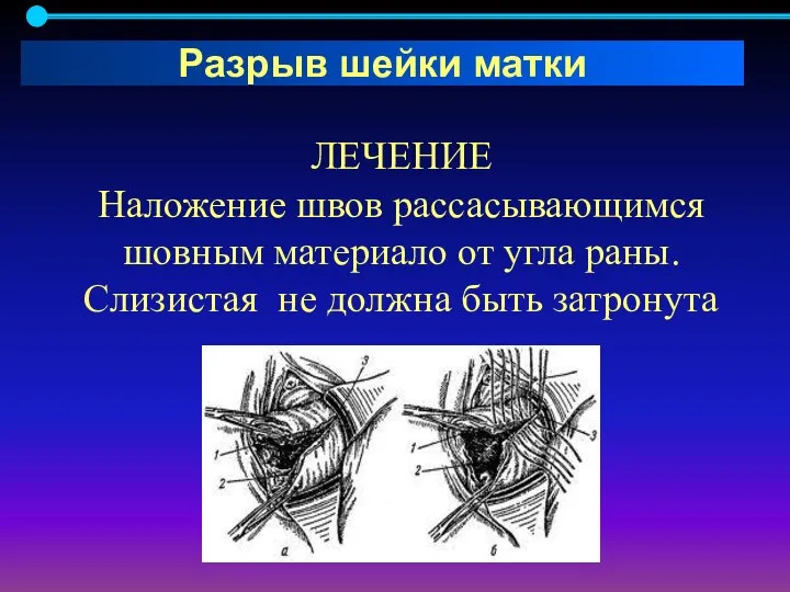 ЛЕЧЕНИЕ Наложение швов рассасывающимся шовным материало от угла раны. Слизистая не должна