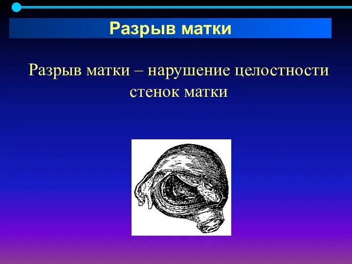 Разрыв матки – нарушение целостности стенок матки Разрыв матки