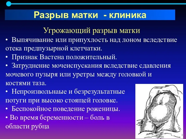 Угрожающий разрыв матки • Выпячивание или припухлость над лоном вследствие отека предпузырной