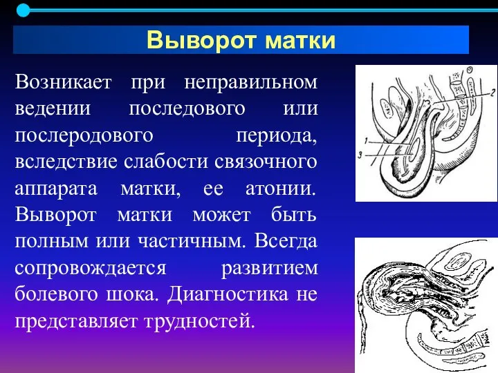 Возникает при неправильном ведении последового или послеродового периода, вследствие слабости связочного аппарата