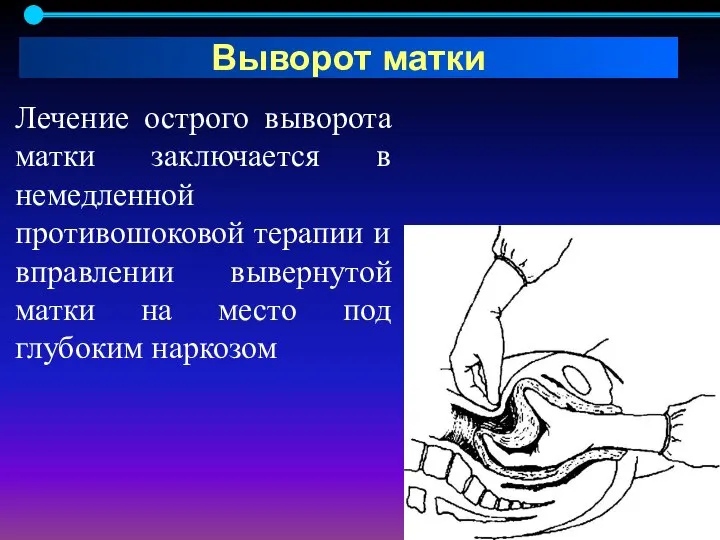 Лечение острого выворота матки заключается в немедленной противошоковой терапии и вправлении вывернутой