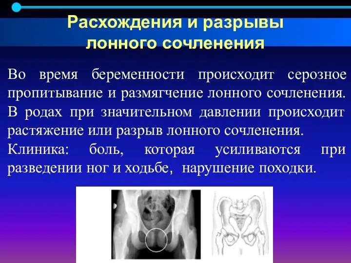 Во время беременности происходит серозное пропитывание и размягчение лонного сочленения. В родах