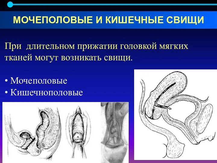 При длительном прижатии головкой мягких тканей могут возникать свищи. • Мочеполовые •