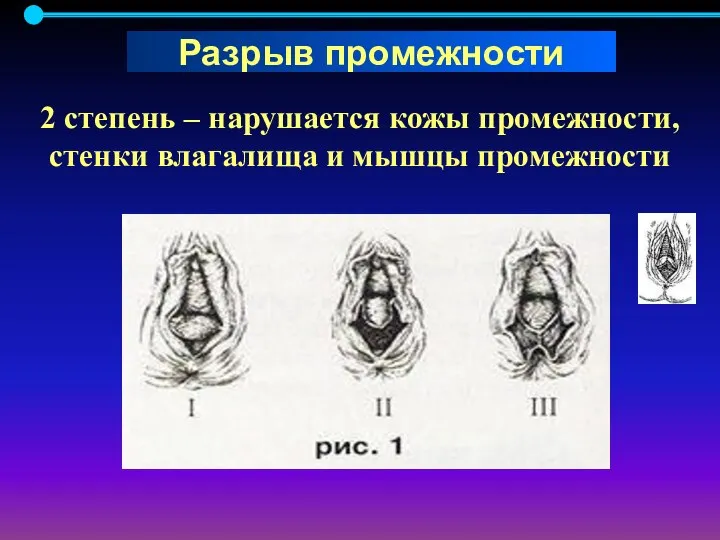 2 степень – нарушается кожы промежности, стенки влагалища и мышцы промежности Разрыв промежности