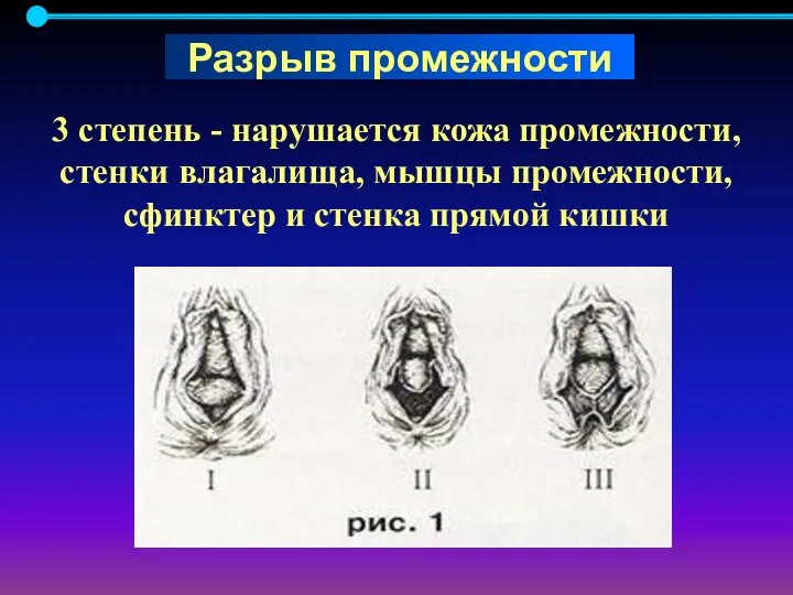 3 степень - нарушается кожа промежности, стенки влагалища, мышцы промежности, сфинктер и