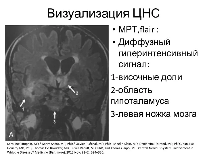 Визуализация ЦНС МРТ,flair : Диффузный гиперинтенсивный сигнал: 1-височные доли 2-область гипоталамуса 3-левая ножка мозга