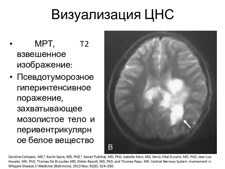 Визуализация ЦНС МРТ, T2 взвешенное изображение: Псевдотуморозное гиперинтенсивное поражение, захватывающее мозолистое тело и перивентрикулярное белое вещество