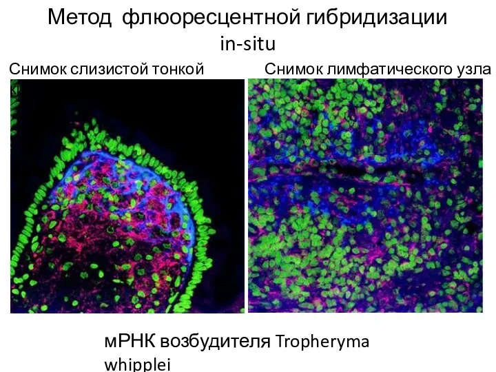 Метод флюоресцентной гибридизации in-situ мРНК возбудителя Tropheryma whipplei Снимок лимфатического узла Снимок слизистой тонкой кишки