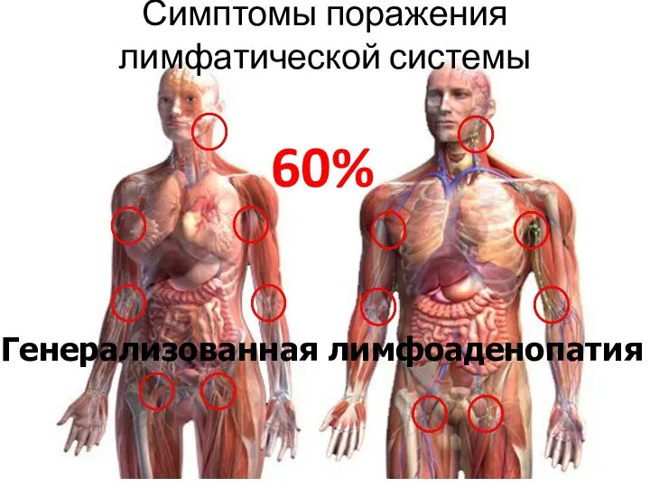 Симптомы поражения лимфатической системы 60% Генерализованная лимфоаденопатия