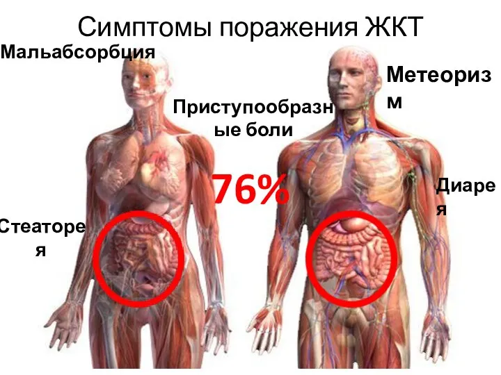 Симптомы поражения ЖКТ Диарея Стеаторея Метеоризм Приступообразные боли Мальабсорбция 76%