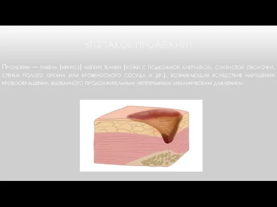 ЧТО ТАКОЕ ПРОЛЕЖНИ? Пролежни — гибель (некроз) мягких тканей (кожи с подкожной