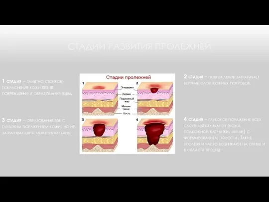 СТАДИИ РАЗВИТИЯ ПРОЛЕЖНЕЙ 1 стадия – заметно стойкое покраснение кожи без её