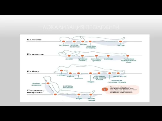 ЛОКАЛИЗАЦИЯ ПРОЛЕЖНЕЙ