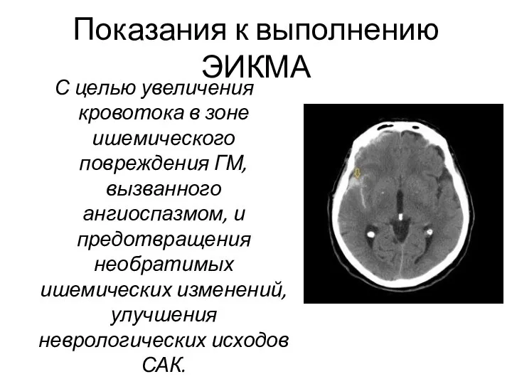 Показания к выполнению ЭИКМА С целью увеличения кровотока в зоне ишемического повреждения