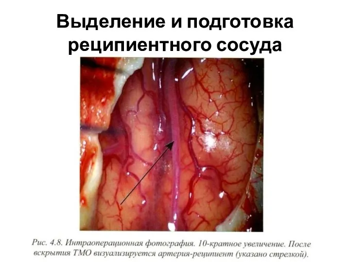 Выделение и подготовка реципиентного сосуда