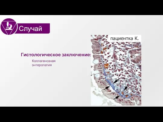 Гистологическое заключение: Коллагенозная энтеропатия Случай #1 пациентка К.