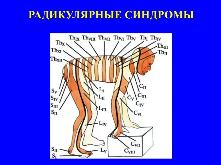 РАДИКУЛЯРНЫЕ СИНДРОМЫ