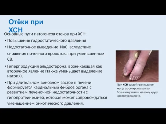 Отёки при ХСН Основные пути патогенеза отеков при ХСН: Повышение гидростатического давления