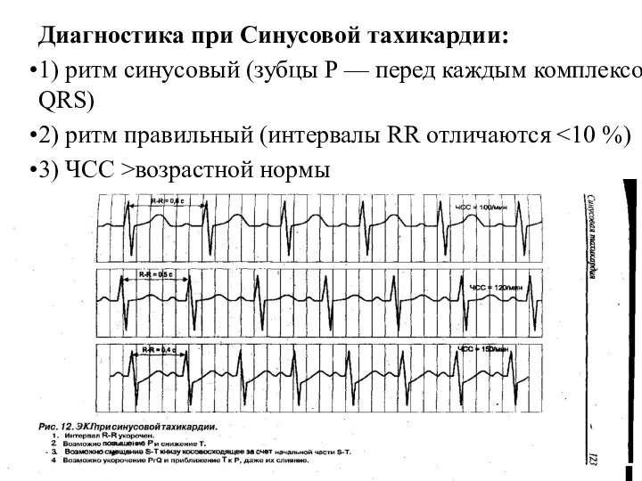 Диагностика при Синусовой тахикардии: 1) ритм синусовый (зубцы P — перед каждым