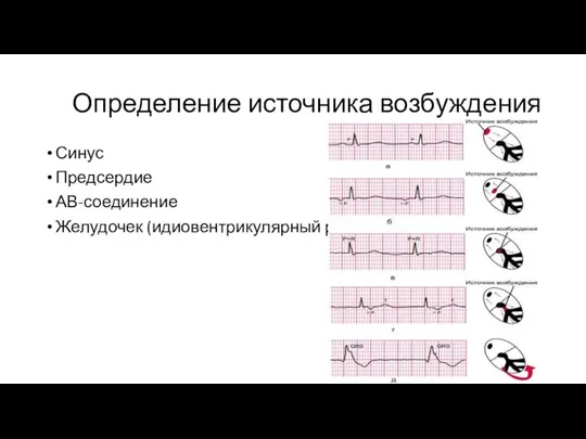 Определение источника возбуждения Синус Предсердие АВ-соединение Желудочек (идиовентрикулярный ритм)