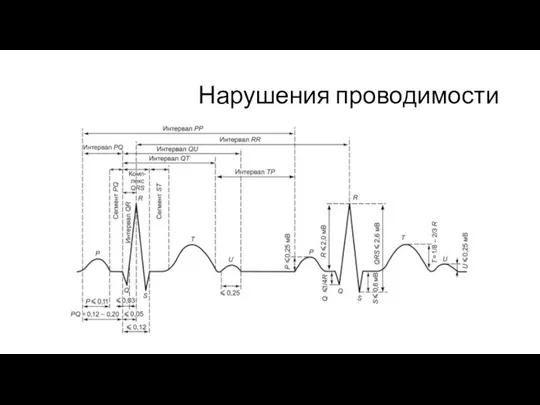 Нарушения проводимости