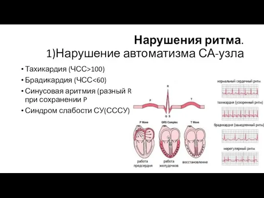 Нарушения ритма. 1)Нарушение автоматизма СА-узла Тахикардия (ЧСС>100) Брадикардия (ЧСС Синусовая аритмия (разный