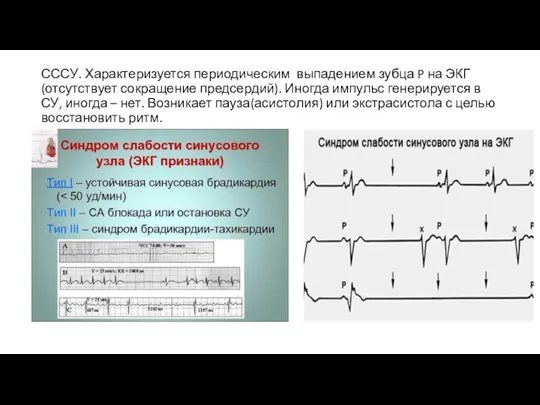 СССУ. Характеризуется периодическим выпадением зубца P на ЭКГ(отсутствует сокращение предсердий). Иногда импульс