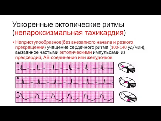 Ускоренные эктопические ритмы(непароксизмальная тахикардия) Неприступообразное(без внезапного начала и резкого прекращения) учащение сердечного