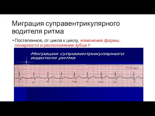 Миграция суправентрикулярного водителя ритма Постепенное, от цикла к циклу, изменение формы, полярности и расположения зубца P