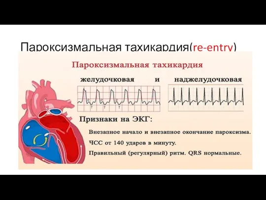 Пароксизмальная тахикардия(re-entry) - Внезапное начало и внезапное прекращение приступа учащения ЧСС >140