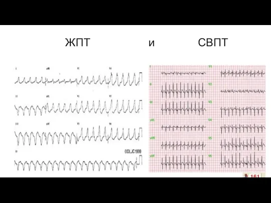 ЖПТ и СВПТ