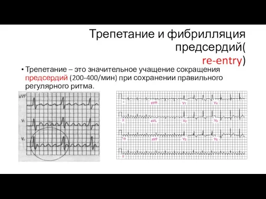 Трепетание и фибрилляция предсердий( re-entry) Трепетание – это значительное учащение сокращения предсердий