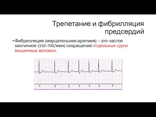 Трепетание и фибрилляция предсердий Фибрилляция (мерцательная аритмия) – это частое хаотичное (350-700/мин)