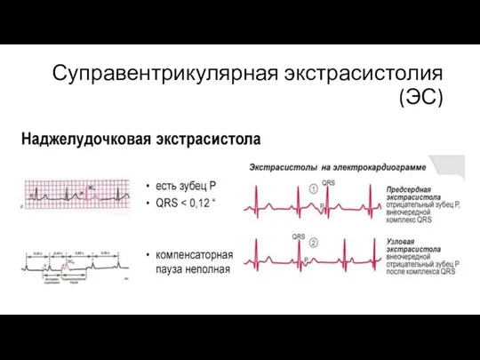 Суправентрикулярная экстрасистолия (ЭС)