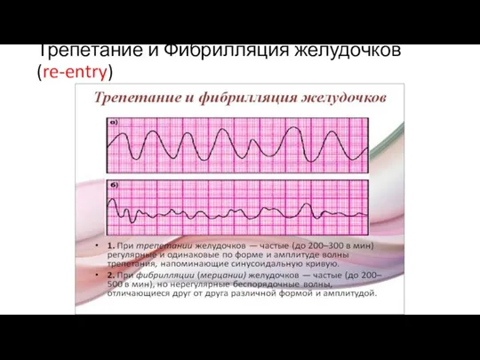Трепетание и Фибрилляция желудочков (re-entry)