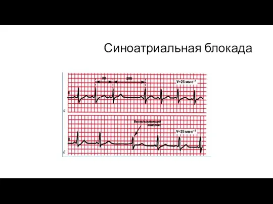 Синоатриальная блокада