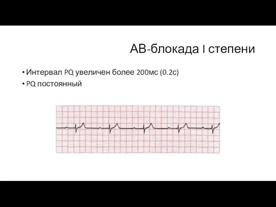 АВ-блокада I степени Интервал PQ увеличен более 200мс (0.2с) PQ постоянный