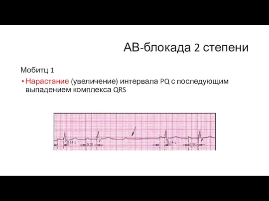 АВ-блокада 2 степени Мобитц 1 Нарастание (увеличение) интервала PQ с последующим выпадением комплекса QRS