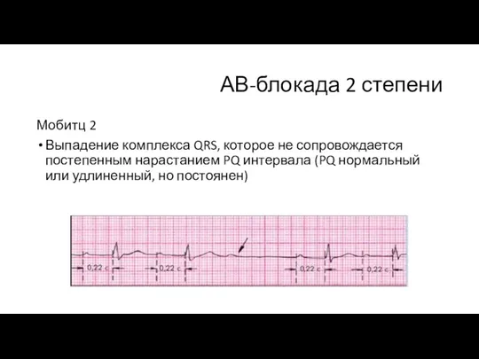 АВ-блокада 2 степени Мобитц 2 Выпадение комплекса QRS, которое не сопровождается постепенным