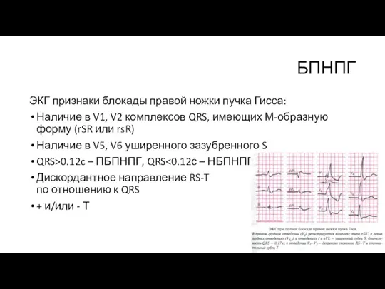 БПНПГ ЭКГ признаки блокады правой ножки пучка Гисса: Наличие в V1, V2