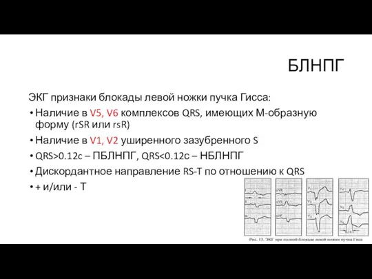 БЛНПГ ЭКГ признаки блокады левой ножки пучка Гисса: Наличие в V5, V6