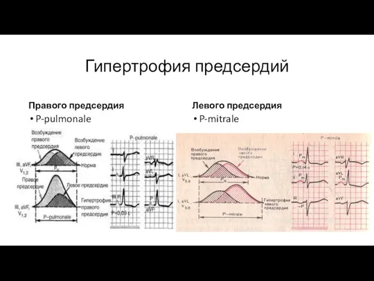 Гипертрофия предсердий Правого предсердия P-pulmonale Левого предсердия P-mitrale