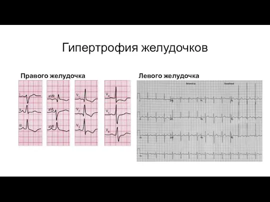 Гипертрофия желудочков Правого желудочка Левого желудочка