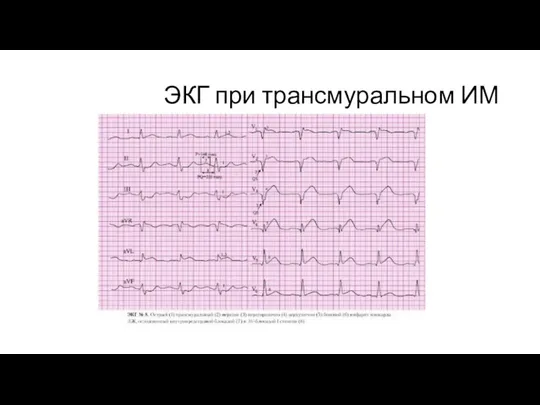 ЭКГ при трансмуральном ИМ