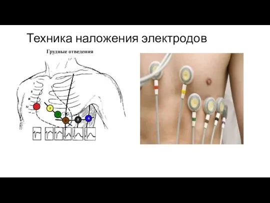 Техника наложения электродов