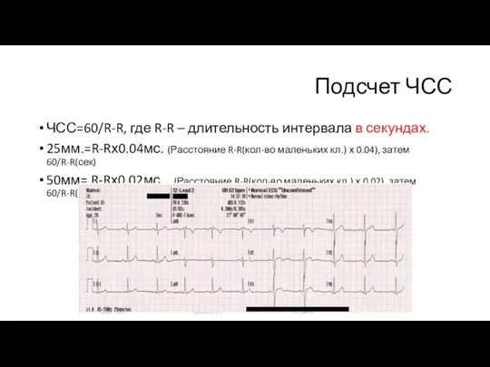 Подсчет ЧСС ЧСС=60/R-R, где R-R – длительность интервала в секундах. 25мм.=R-Rх0.04мс. (Расстояние