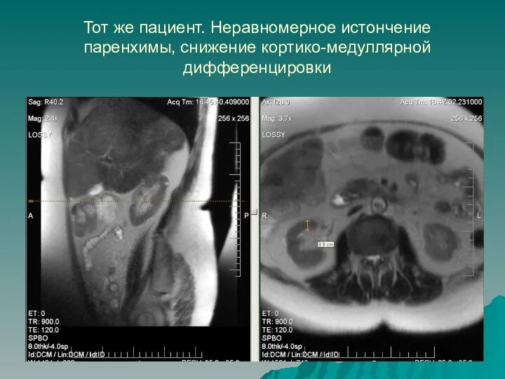 Тот же пациент. Неравномерное истончение паренхимы, снижение кортико-медуллярной дифференцировки