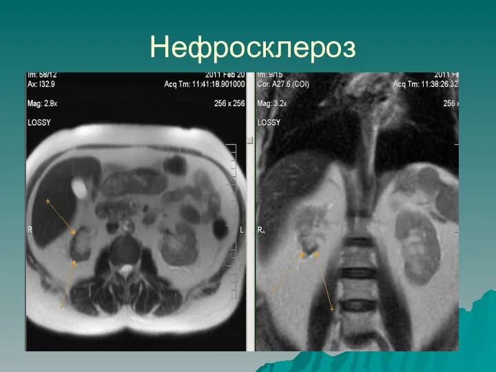 Нефросклероз