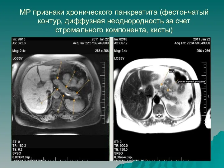 МР признаки хронического панкреатита (фестончатый контур, диффузная неоднородность за счет стромального компонента, кисты)